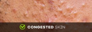 congested skin