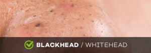 blackhead and whitehead