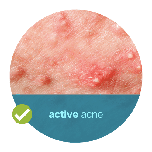 Active Acne