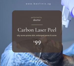 Carbon Laser Peel promotion