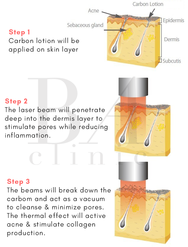 Step-by-step Carbon Laser Peel treatment process showing carbon application, laser delivery, and pore-cleansing effect