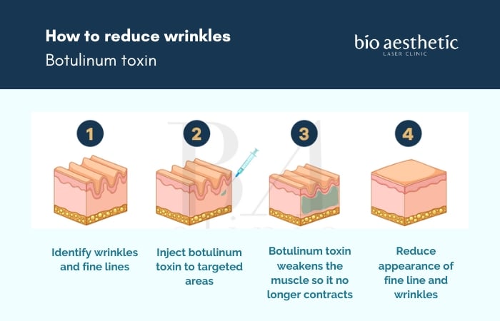 botox botulinum toxin wrinkles