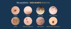 mole removal singapore bio aesthetic laser clinic types of moles