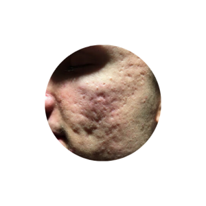 Rolling deep acne scars subcision