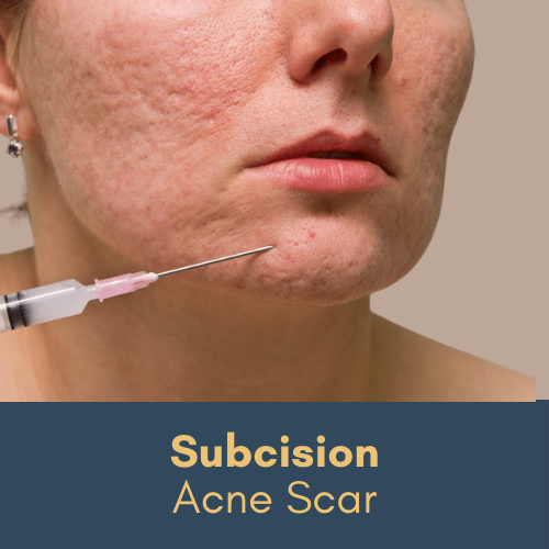 subcision acne scar