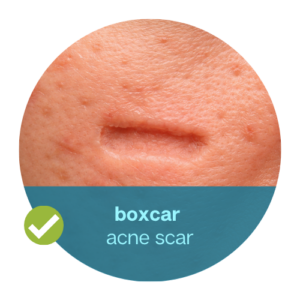 boxcar acne scar