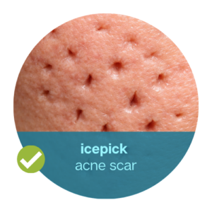 ice pick acne scar