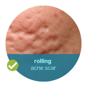 rolling acne scar