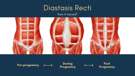 how does diastasis recti happen?