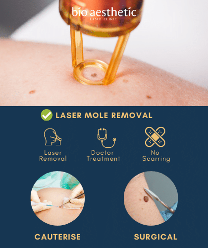mole removal singapore bio aesthetic laser clinic laser mole removal benefits