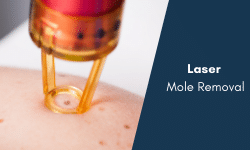 laser mole removal