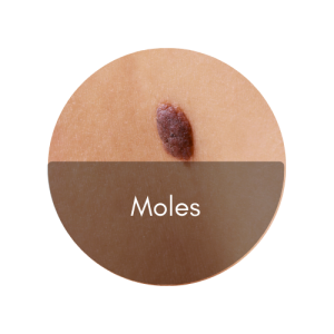 mole removal