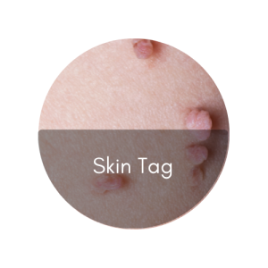 skin tag removal
