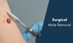 surgical mole removal