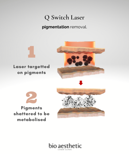 how to remove pigmentation sun spots with q switch laser