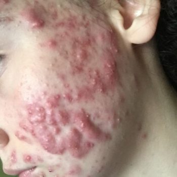 cystic acne face cheeks