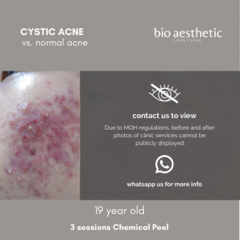 cystic acne treatment chemical peel
