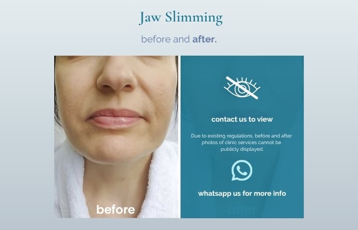 jaw botox before and after