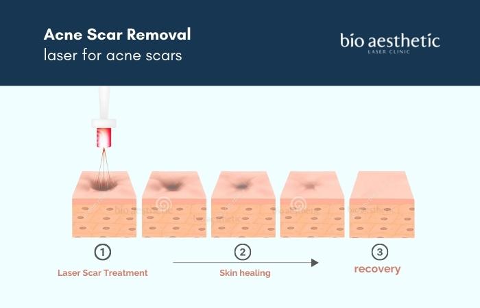 laser acne scar removal