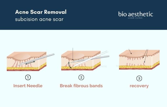 subcision acne scar removal