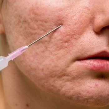 subcision how to remove acne scars