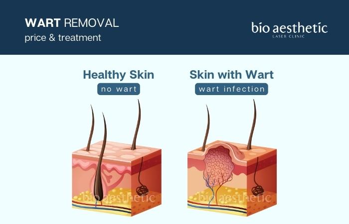 wart removal
