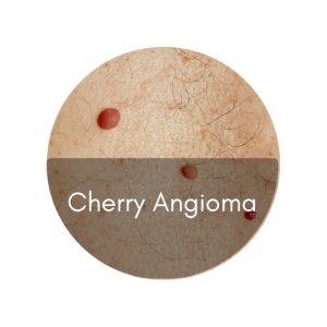 cherry angioma