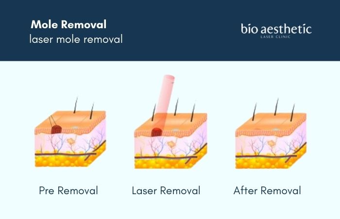 laser mole removal review