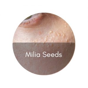 milia seed