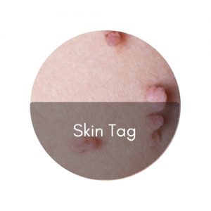 skin tag
