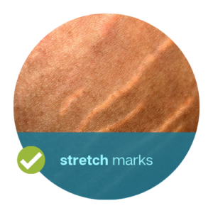 stretch marks