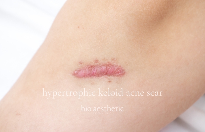 Hypertrophic keloid acne scar