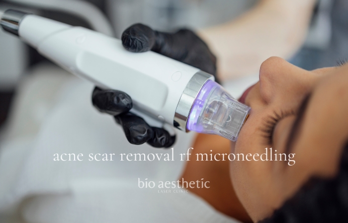 acne scar treatment rf microneedling price