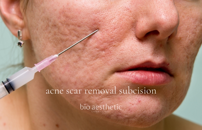 acne scar treatment subcision price