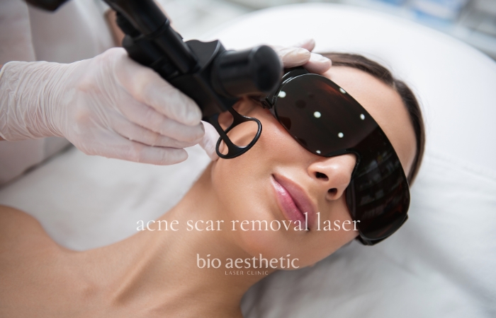cost of acne scar treatment laser