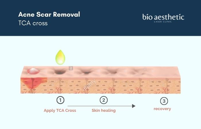 tca cross chemical peel for acne scar