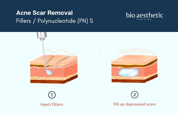 rejuran s acne scar removal