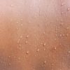 Back Acne: Causes, Treatment, Prevention and Symptoms