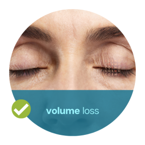 volume loss