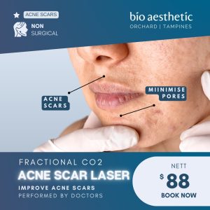 Acne scar laser treatment Singapore promotion