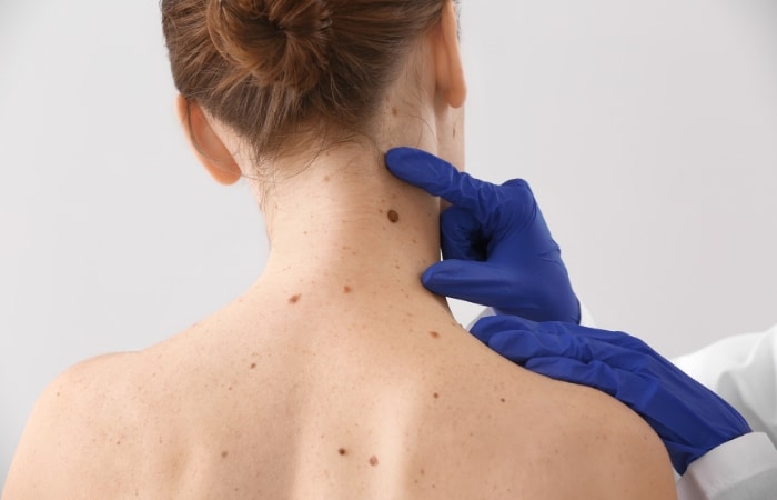 Additional Professional Options for MOLE REMOVAL Scar Management