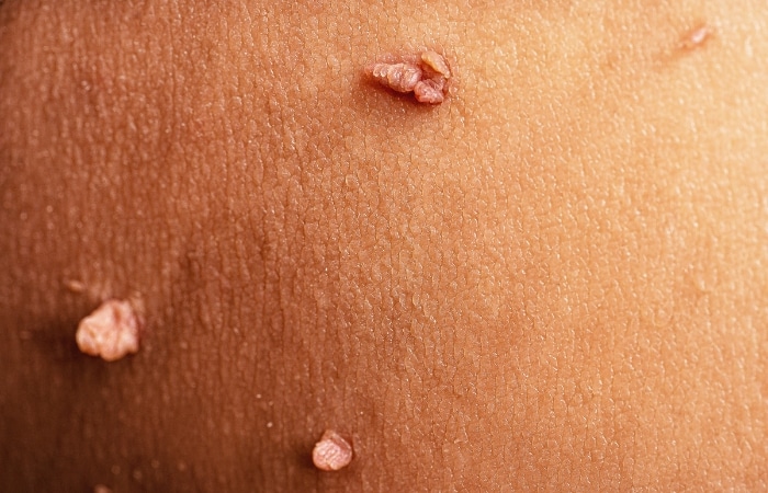skin tag removal