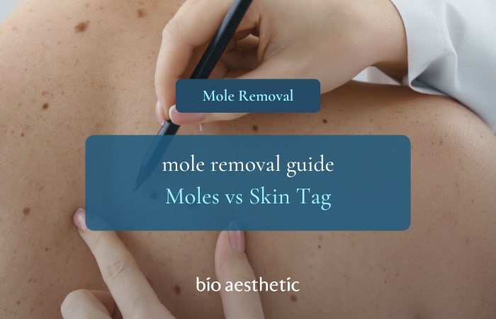 skin tag vs mole