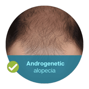 Androgenetic alopecia (pattern hair loss)