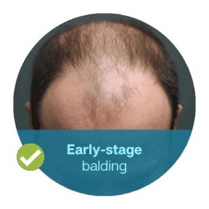 Early-stage balding where donor supply is still present