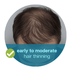 Early to moderate thinning of hair