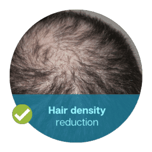 Hair density reduction