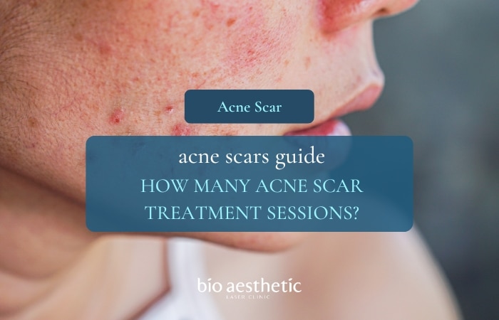 How Many Acne Scar Treatment Sessions Do You Really Need? Mild vs Moderate vs Severe Scars