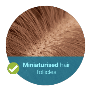 Miniaturised hair follicles