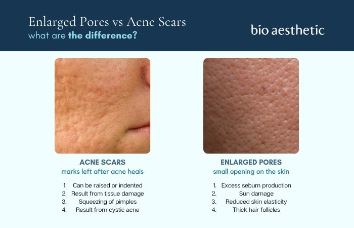 enlarged pores vs acne scars